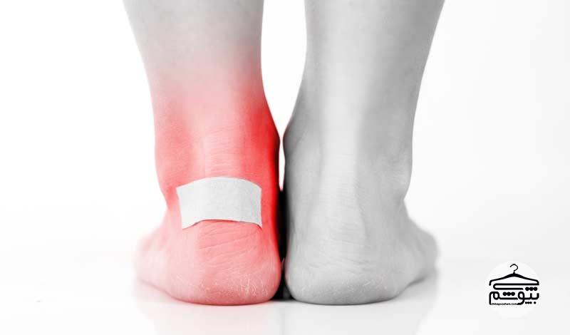 درمان تاول پا