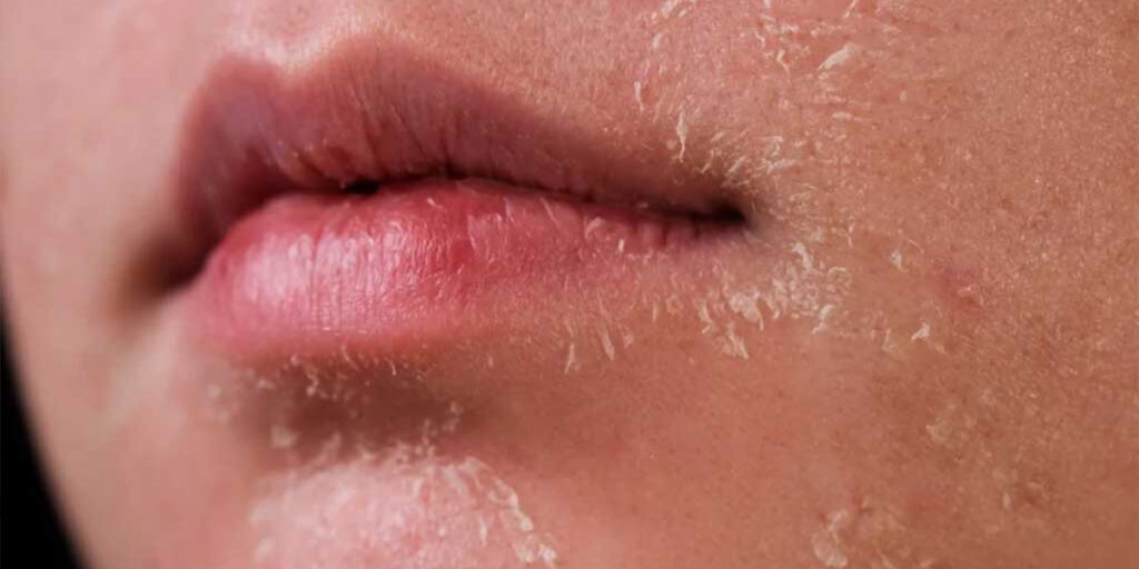 8 درمان خانگی خشکی پوست که باید امتحان کنید؛ با این ترفندها پوست‌تان همیشه شاداب است!