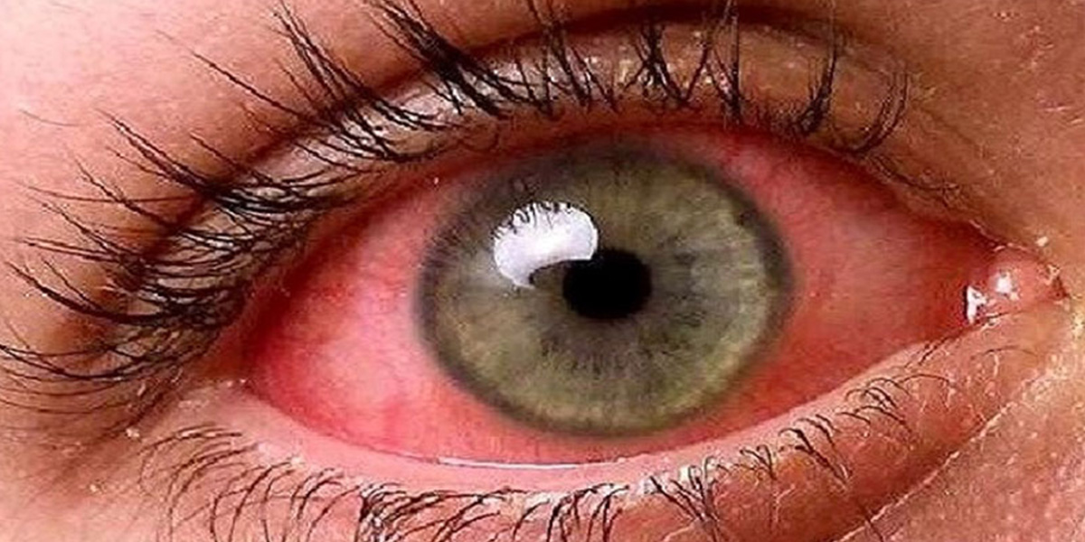علت قرمزی چشم