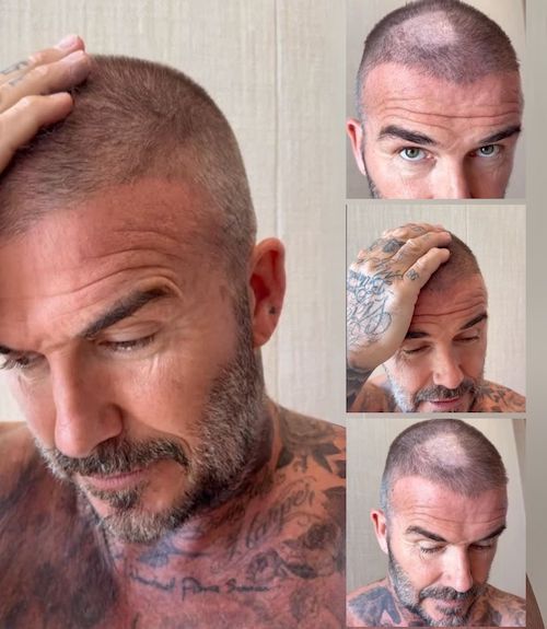 کچل شدن دیوید بکهام