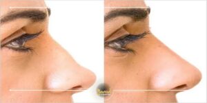 نوک بینی‌تان را بدون تغییرات گسترده اصلاح کنید