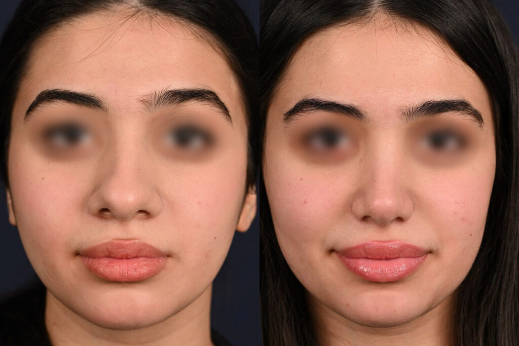 چگونه بینی بزرگ را کوچک کنیم؟