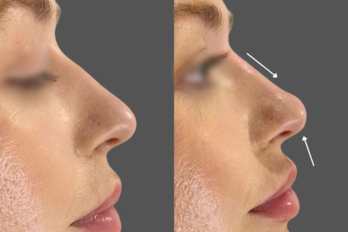 کوچک کردن بینی