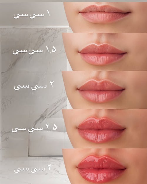میزان ژل تزریقی به لب