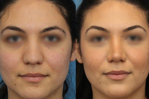 کوچک کردن بینی