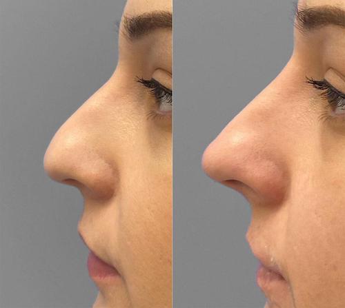 ترند قوز بینی