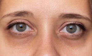 بهترین روش‌ها برای رفع تیرگی دور چشم؛ تنها سه روز این راهکارها را اجرا کنید!