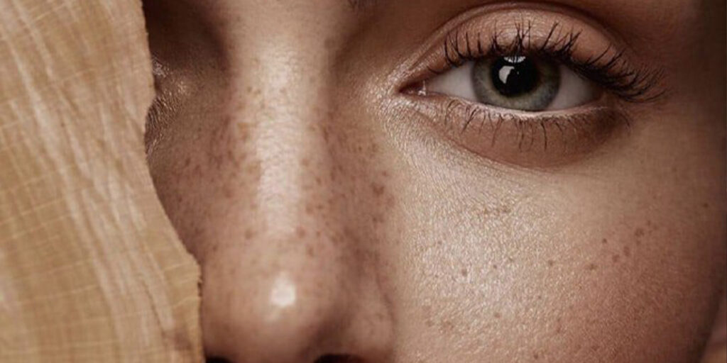 چرا داشتن کک و مک ناگهان انقدر محبوب شد؟ هرآنچه لازم است درباره کک و مک بدانید