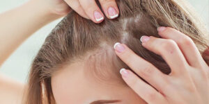 ماینوکسیدیل چیست و چگونه در درمان ریزش مو، معجره می‌کند؟